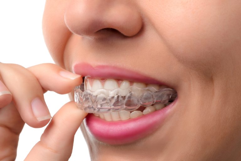 Med Invisalign kan du få rettet dine tænder helt usynligt